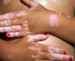 vitiligo (1)